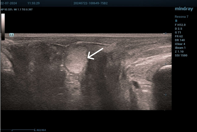 Эхограмма 1