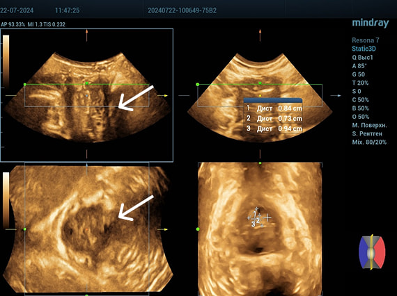 Эхограмма 3