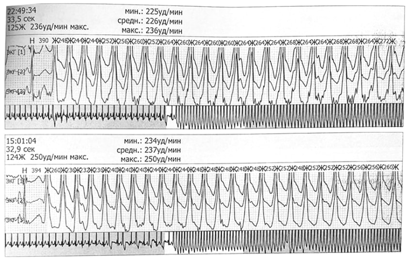 Показатели ХМЭКГ
