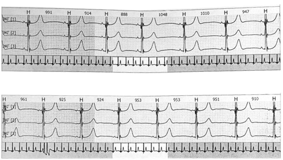 Показатели ХМЭКГ