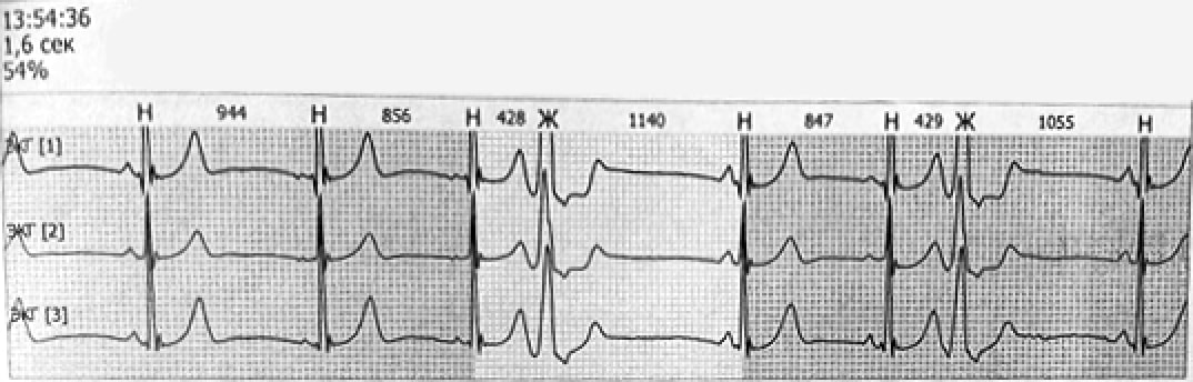 Показатели ХМЭКГ